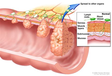 Understanding Colorectal Cancer | Knight Cancer Institute| OHSU