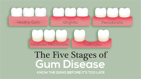 The Five Stages of Gum Disease — The McKenzie Center | Implants & Periodontics