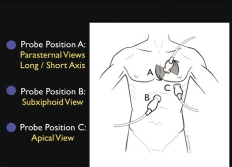 Cardiac ultrasound - WikEM