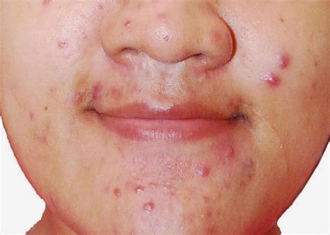 Pimples Face: Acne skin disease for young people