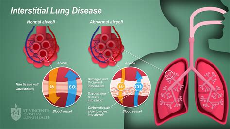 Mesothelioma And Non Small Cell Lung Cancer