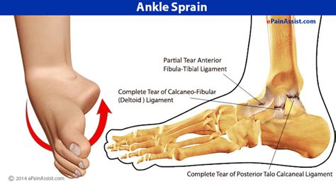 sprained ankle treatment – Convenient How to trade options Methods ...