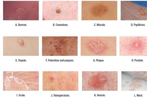 Identify Skin Lesions