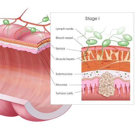 Colorectal Cancer - Staging - Digestive Cancers Europe