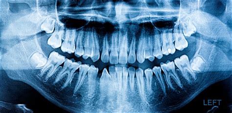 Oral & Dental X-Rays, Xrays Of Teeth Burlington | Britannia Dental Centre