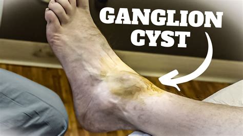 Ganglion Cyst Foot Surgery Recovery Time [Causes & Best Treatment]