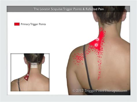 Levator Scapulae Trigger Points: Frankenstein Pain ...