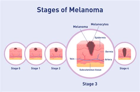 Stage 3 - Melanoma Focus