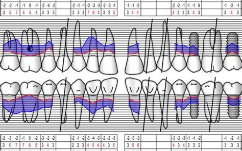 How To Chart Periodontal Probing - Best Picture Of Chart Anyimage.Org