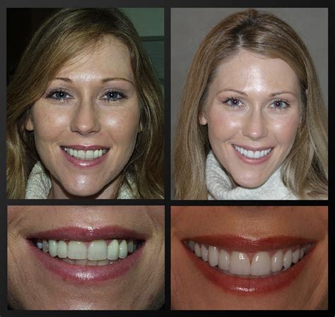 Porcelain Veneers Rochester, MI | Rochester Advanced Dentistry