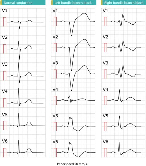 Left bundle branch block (LBBB): ECG criteria, causes, management – Cardiovascular Education