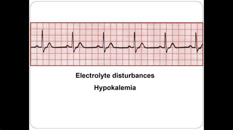 Hypokalemia Ecg