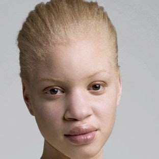 Albino White People