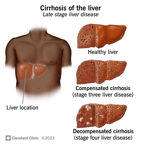 Cirrhosis of the Liver: Signs & Symptoms, Causes, Stages