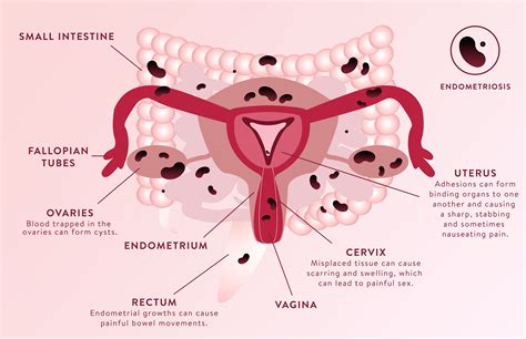 This Is What Endometriosis Does to Your Body