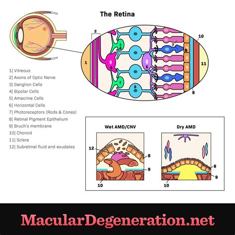 Wet Amd Macular Degeneration