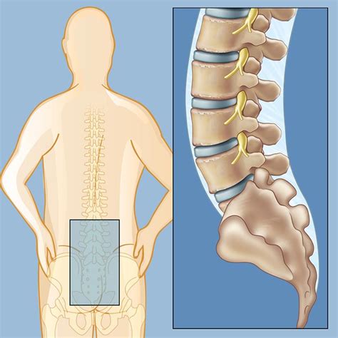 Lower Back Pain | Weill Cornell Brain and Spine Center