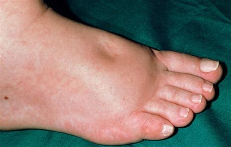 Causes Of Swollen Ankles In Diabetics - DiabetesWalls