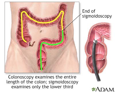 Colorectal polyps Information | Mount Sinai - New York