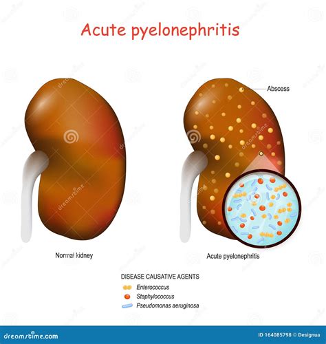 Acute pyelonephritis stock vector. Illustration of nephritis - 164085798