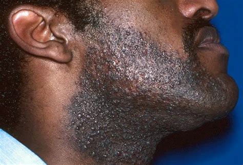 Rosacea, Acne, Shingles, Covid-19 Rashes: Common Adult Skin Diseases