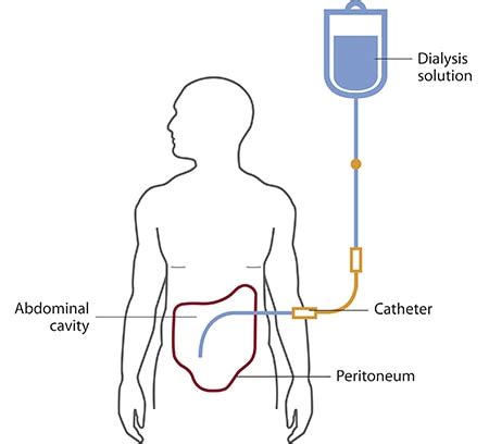 Peritoneal Dialysis | NIDDK