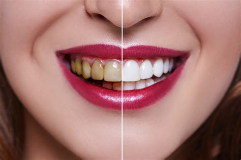 How long do veneers last? Hint: it depends on the material