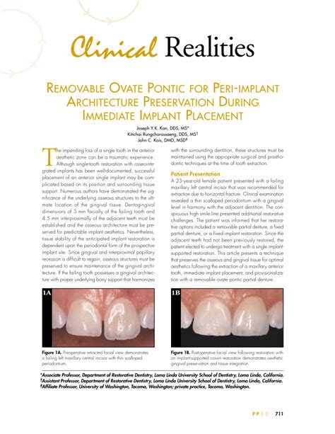 (PDF) Removable ovate pontic for peri-implant architecture preservation during immediate implant ...