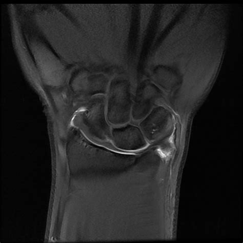 Ulnar Collateral Ligament Wrist Mri