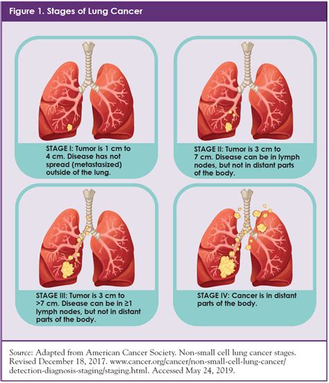 Lung Cancer Staging Diagram