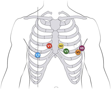 Paediatric ECG lead placement • LITFL • ECG Library Diagnosis