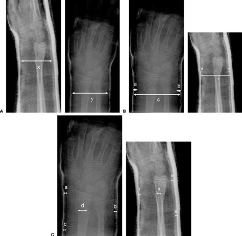 Figure 2 from Pediatric distal radius and forearm fractures. | Semantic ...