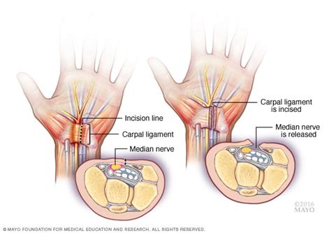 Carpal tunnel release - Mayo Clinic