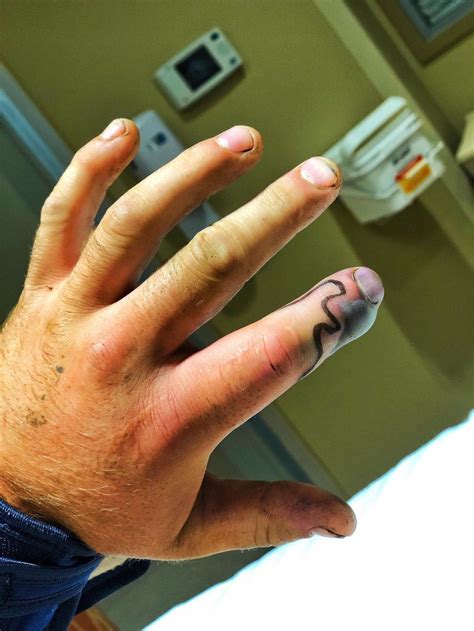 Tennessee Man's Finger Swells to Size of a Lemon After He Delays Treating 'Freak' Rattlesnake Bite