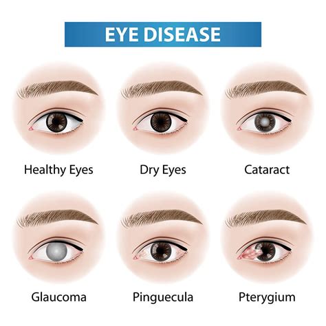 Beware of These Common Eye Diseases | Bangkok Hospital