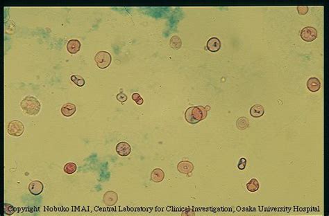 Dysmorphic red blood cells from the urinary sediment of a patient with cystitis. In a case of ...