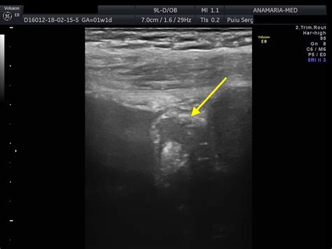 Ultrasound diagnosis of bladder endometriosis [Dec 2022] – EFSUMB