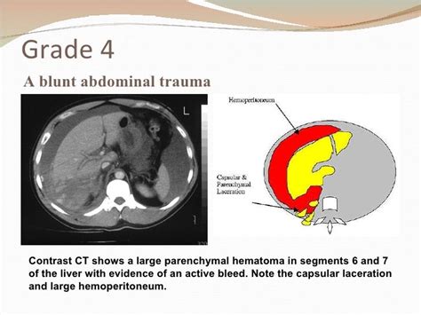 Liver Trauma