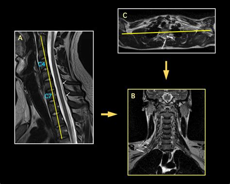 Mri Brachial Plexus Anatomy | Images and Photos finder