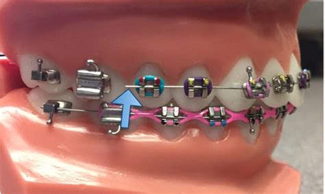 Poking or broken wire | Tustin, CA | Legacy Orthodontics