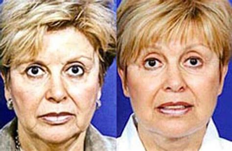 High SMAS (Superficial Muscular Aponeurotic System) Facelift