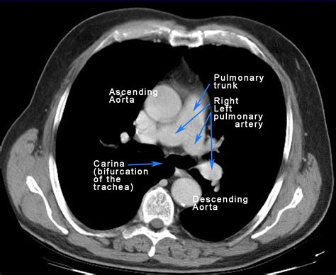 Pulmonary Artery Branch Anatomy