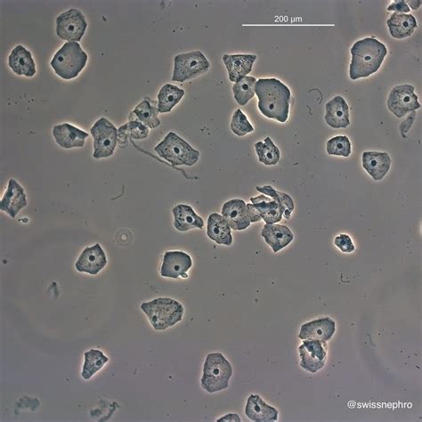 Urine Sediment of the Month: 4 Flavors of Nucleated Cells - Renal Fellow Network