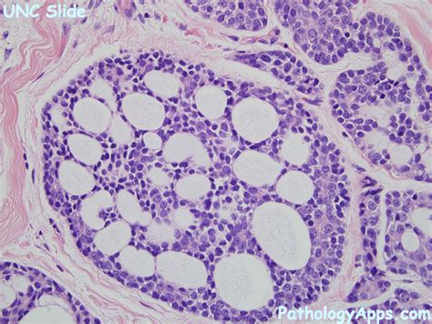 adenoid cystic carcinoma salivary gland histology