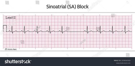 Sinoatrial Sa Block Ecg 8 Second Stock Vector (Royalty Free) 2258363565 ...