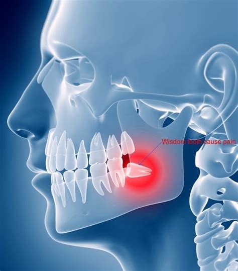 Tooth infection - Causes, Symptoms, Prevention & Treatment