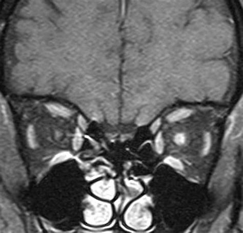 Optic Neuritis