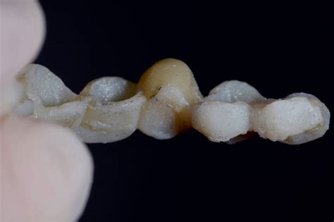 Dental Esthetics: Ovate pontic for the correct emergence profile.. A clinical case