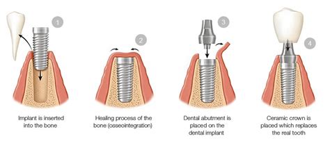 Dental Implants can restore Missing or Damaged Teeth