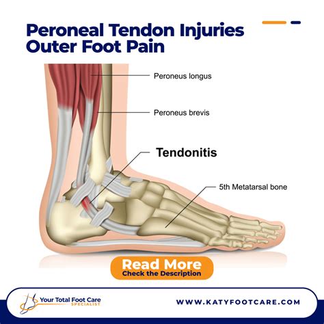 Tendonitis Side Of Foot Sale | ststephen-pc.gov.uk